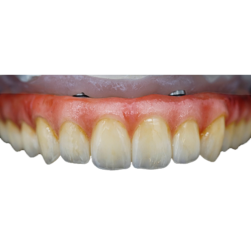 Full Arch restoration