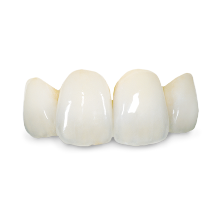 PMMA Provisionals